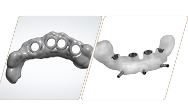 數字化種植牙3D手術導板打印